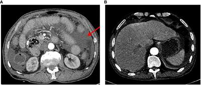 Case Report: Primary small bowel adenocarcinoma with peritoneal metastasis responded well to a CapeOX + bevacizumab regimen